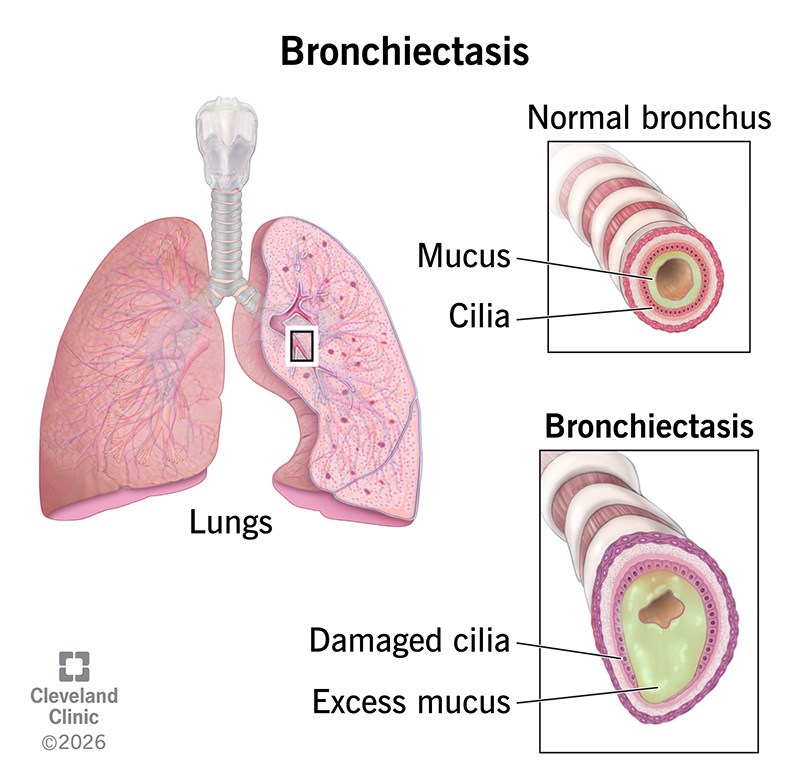 Bronchiectasis airway disease