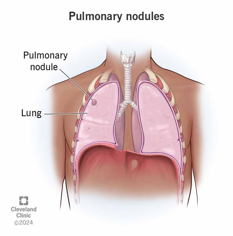 Pulmonary nodule imaging